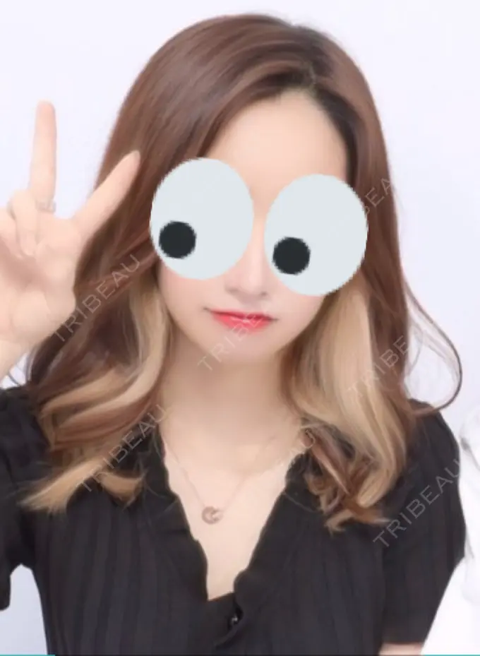 糸リフト / 脂肪吸引（顔） / メーラーファット除去 / ジョールファット除去 / ヒアルロン酸注入（頬） SEA CLINIC（シークリニック） DAY 57 メイン用