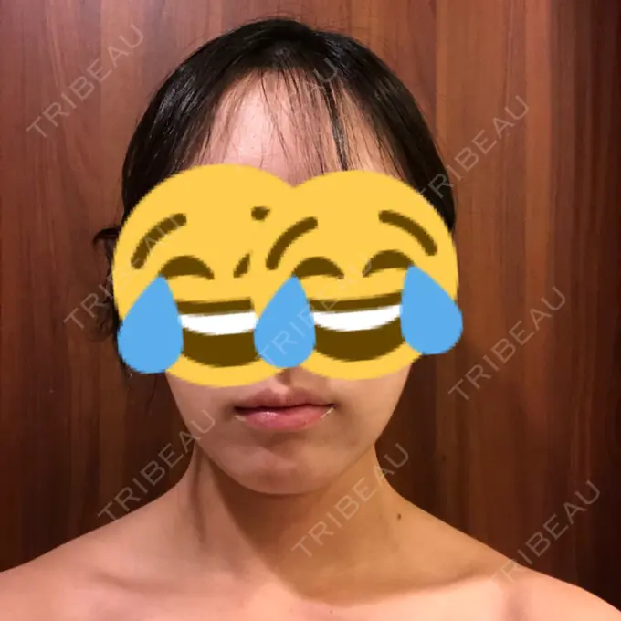 脂肪吸引（顔） THE CLINIC（ザ・クリニック） 東京院 DAY 31 メイン用