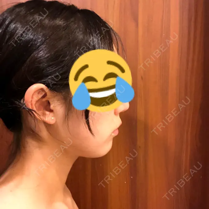 脂肪吸引（顔） THE CLINIC（ザ・クリニック） 東京院 DAY 31 メイン用