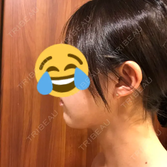 脂肪吸引（顔） THE CLINIC（ザ・クリニック） 東京院 DAY 31 メイン用