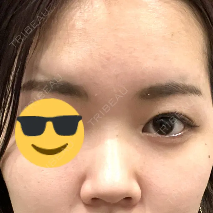 アートメイク（眉） 表参道ウィズ・クリニック DAY 8 メイン用