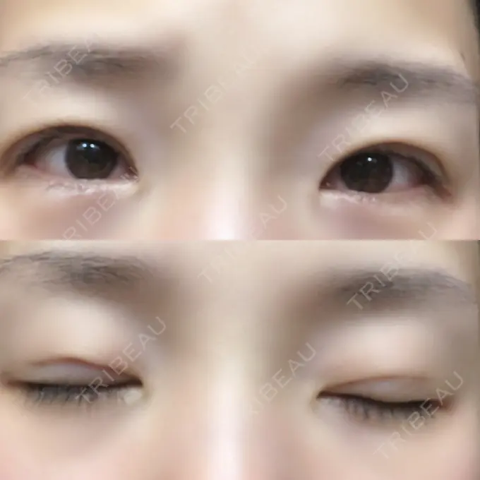 二重埋没 湘南美容クリニック 長野院 DAY 18 メイン用