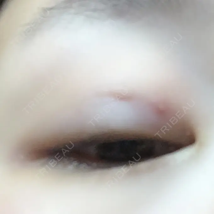 二重埋没 湘南美容クリニック 長野院 DAY 18 メイン用