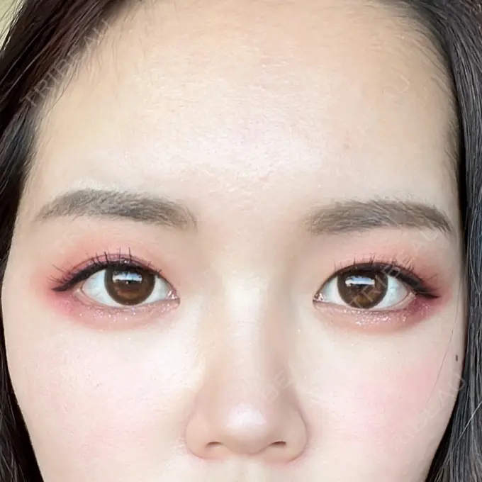 アートメイク（眉） 表参道ウィズ・クリニック DAY 10 メイン用