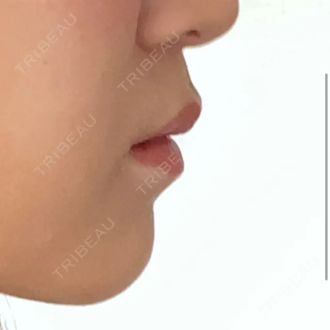 ヒアルロン酸注入（唇） / ボトックス（口角） ルラ美容クリニック 大宮院 / ルラスキンクリニック 大宮院 DAY 24 メイン用