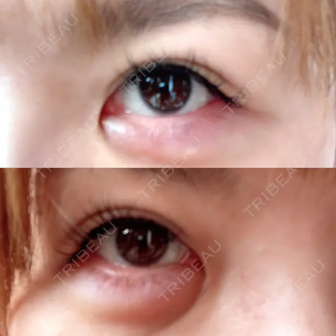 ヒアルロン酸注入（涙袋） / ボトックス（眉間） TCB東京中央美容外科 心斎橋院 DAY 27 メイン用