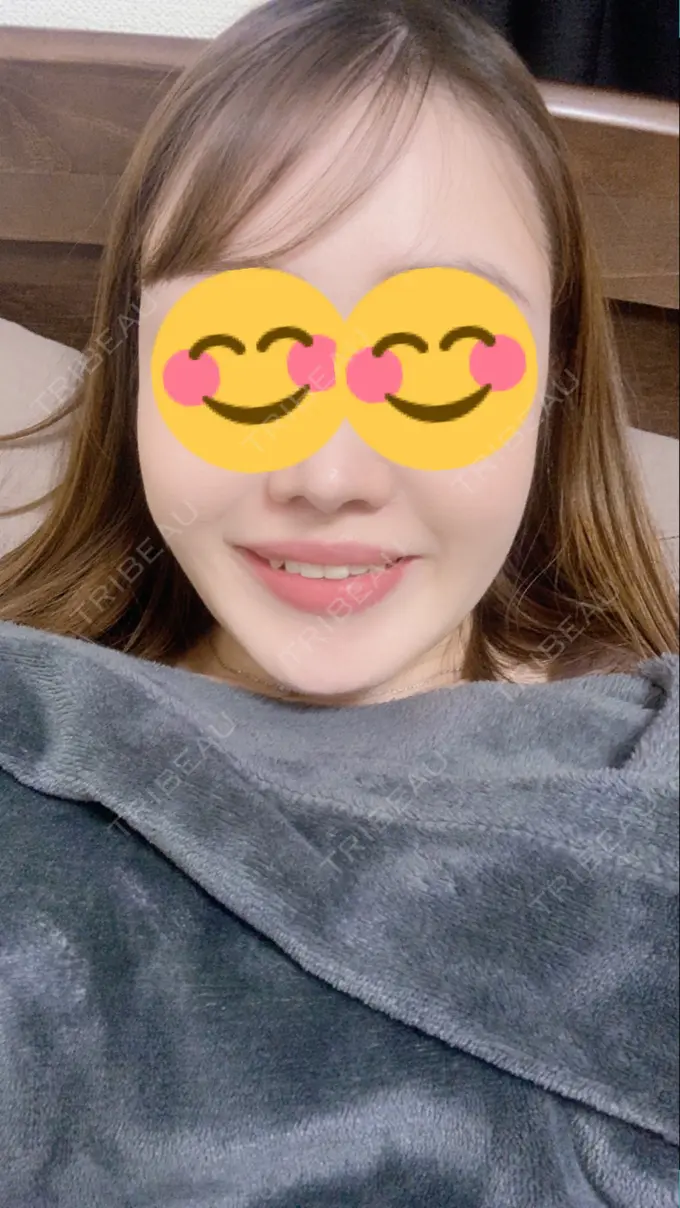 糸リフト / 脂肪吸引（顔） / メーラーファット除去 / ボトックス（エラ・小顔） 湘南美容クリニック 秋葉原院 DAY 37 メイン用