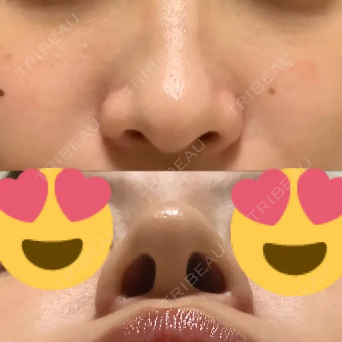 小鼻縮小（切開） / 鼻翼挙上 三輪皮フ科形成外科 DAY 126 メイン用