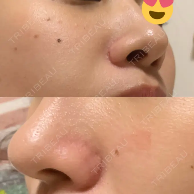 小鼻縮小（切開） / 鼻翼挙上 三輪皮フ科形成外科 DAY 126 メイン用