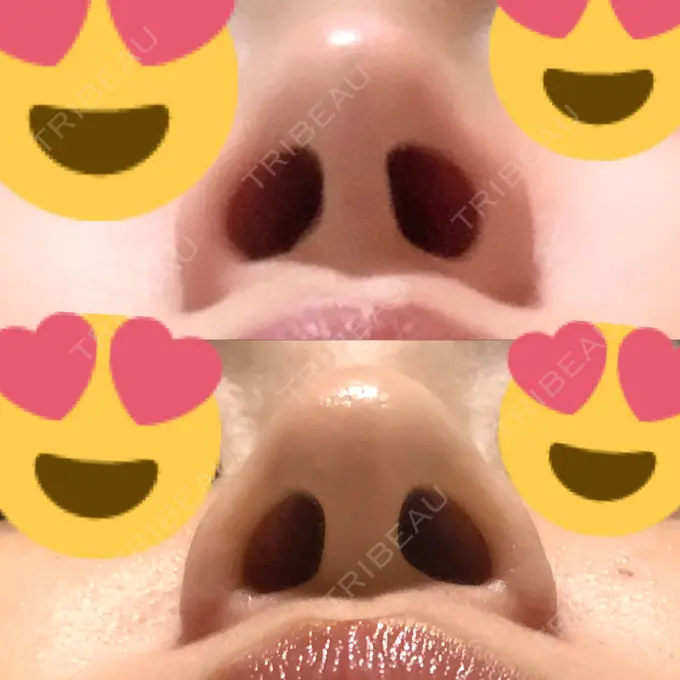小鼻縮小（切開） / 鼻翼挙上 三輪皮フ科形成外科 DAY 126 メイン用