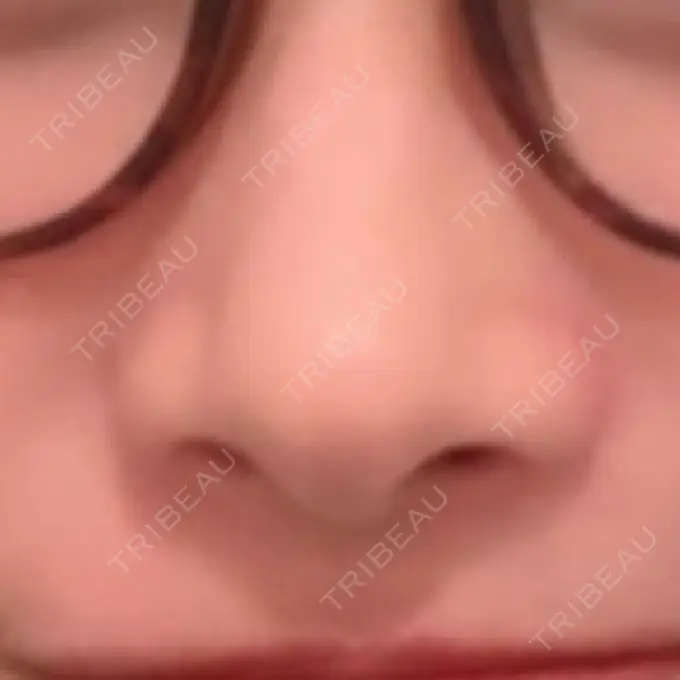 小鼻縮小（切開） / 鼻翼挙上 三輪皮フ科形成外科 DAY 61 メイン用