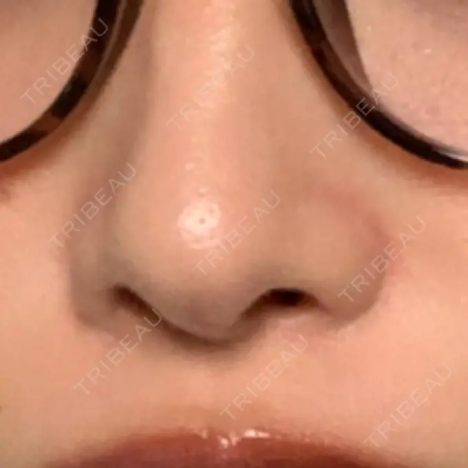 小鼻縮小（切開） / 鼻翼挙上 三輪皮フ科形成外科 DAY 61 メイン用