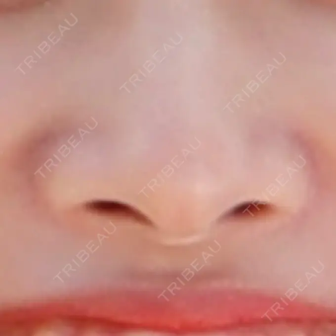 小鼻縮小（切開） / 鼻翼挙上 三輪皮フ科形成外科 DAY 91 メイン用