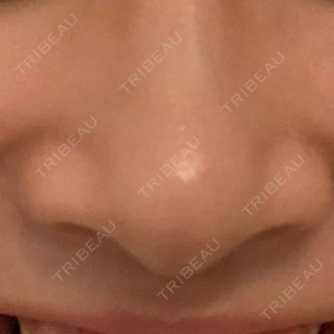 小鼻縮小（切開） / 鼻翼挙上 三輪皮フ科形成外科 DAY 91 メイン用