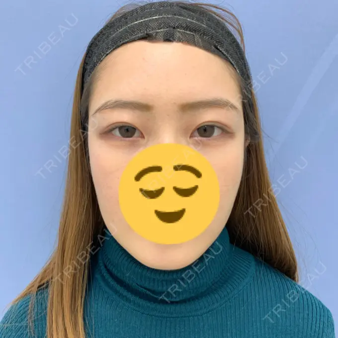 糸リフト / 脂肪吸引（顔） / メーラーファット除去 / ボトックス（エラ・小顔） 湘南美容クリニック 秋葉原院 AFTER メイン用