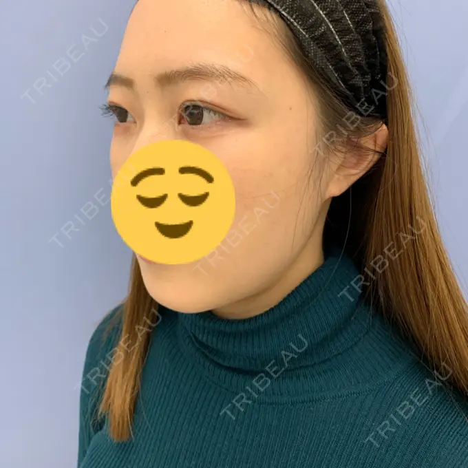 糸リフト / 脂肪吸引（顔） / メーラーファット除去 / ボトックス（エラ・小顔） 湘南美容クリニック 秋葉原院 DAY 38 メイン用