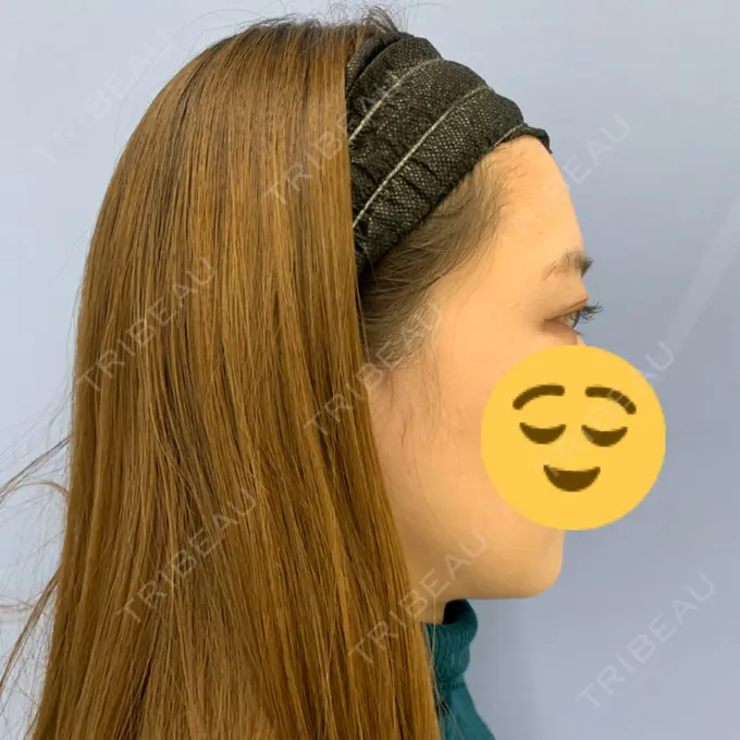 糸リフト / 脂肪吸引（顔） / メーラーファット除去 / ボトックス（エラ・小顔） 湘南美容クリニック 秋葉原院 DAY 38 メイン用