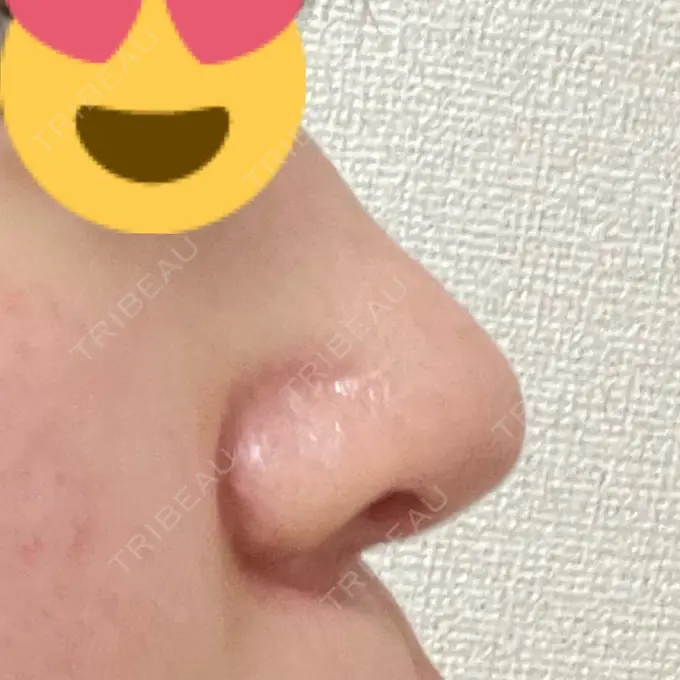 鼻修正 / 鼻孔縁下降 牧野美容クリニック AFTER メイン用