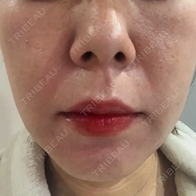 ボトックス（エラ・小顔） TCB東京中央美容外科 心斎橋筋院 DAY 10 メイン用