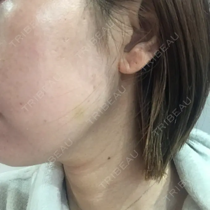 ボトックス（エラ・小顔） TCB東京中央美容外科 心斎橋筋院 DAY 10 メイン用