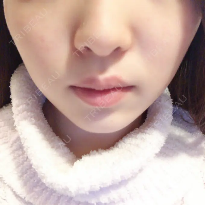 脂肪溶解注射（顔） S Beauty Clinic DAY 26 メイン用