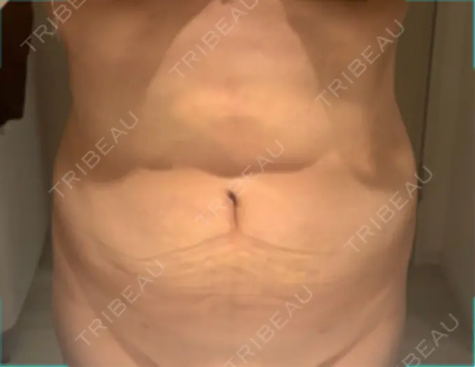 脂肪吸引（お腹） / インディバ（お腹） 藤・ナチュレ美容クリニック 恵比寿院 DAY 32 メイン用
