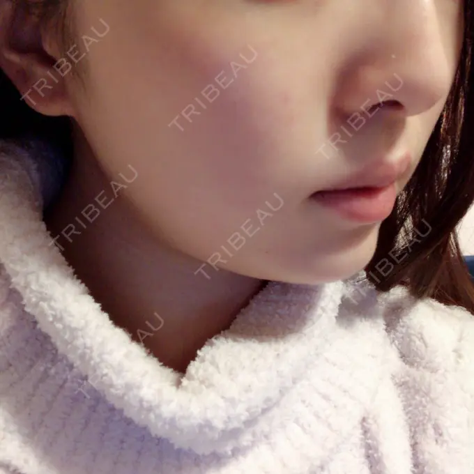 脂肪溶解注射（顔） S Beauty Clinic DAY 26 メイン用