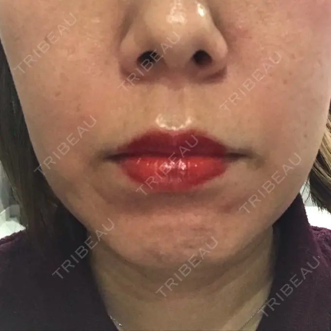 ボトックス（エラ・小顔） TCB東京中央美容外科 心斎橋筋院 DAY 13 メイン用