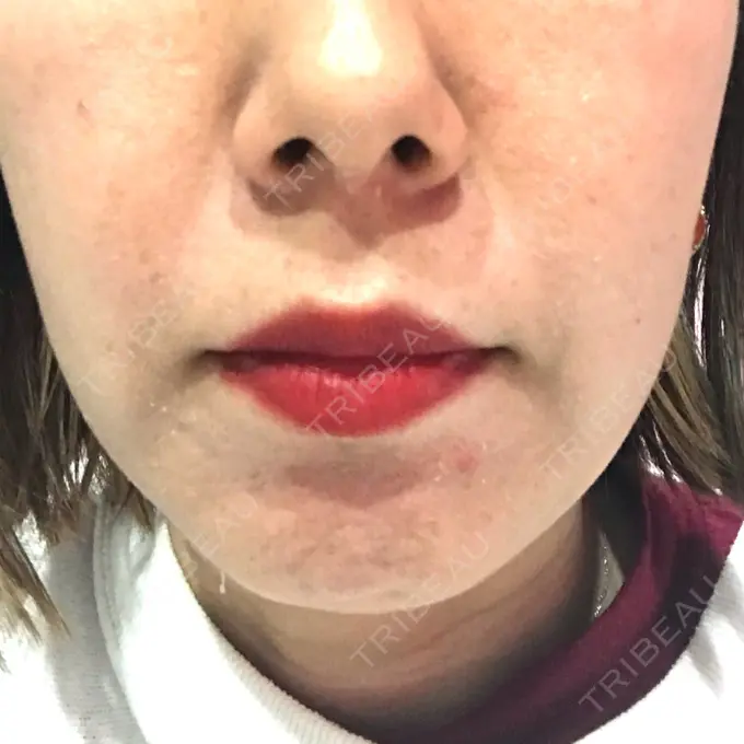 ボトックス（エラ・小顔） TCB東京中央美容外科 心斎橋筋院 DAY 14 メイン用