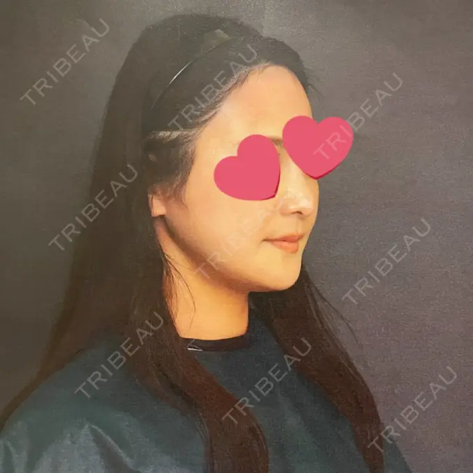 骨切り（あご） / 骨削り（エラ） / 骨削り（頬） アーククリニック DAY 126 メイン用