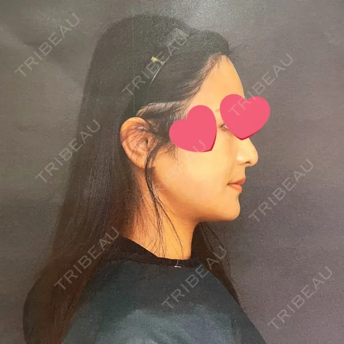 骨切り（あご） / 骨削り（エラ） / 骨削り（頬） アーククリニック DAY 126 メイン用