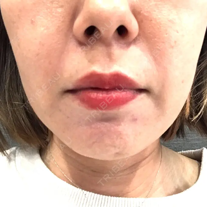 ボトックス（エラ・小顔） TCB東京中央美容外科 心斎橋筋院 DAY 16 メイン用