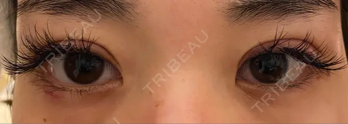 二重切開 / 上まぶたの脂肪取り 心斎橋コムロ美容外科クリニック DAY 18 メイン用