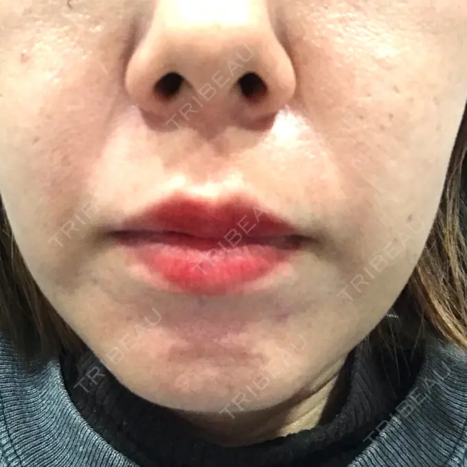 ボトックス（エラ・小顔） TCB東京中央美容外科 心斎橋筋院 DAY 18 メイン用