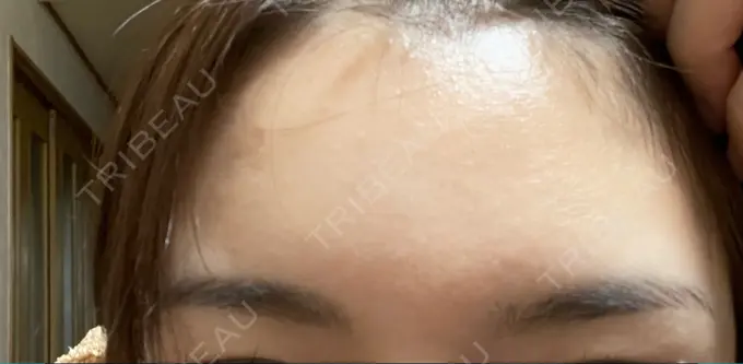 ボトックス（額） TCB東京中央美容外科 静岡院 DAY 16 メイン用