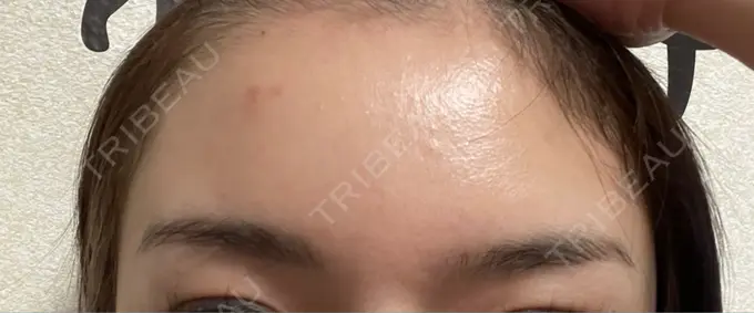 ボトックス（額） TCB東京中央美容外科 静岡院 DAY 15 メイン用