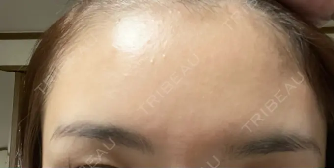 ボトックス（額） TCB東京中央美容外科 静岡院 DAY 14 メイン用