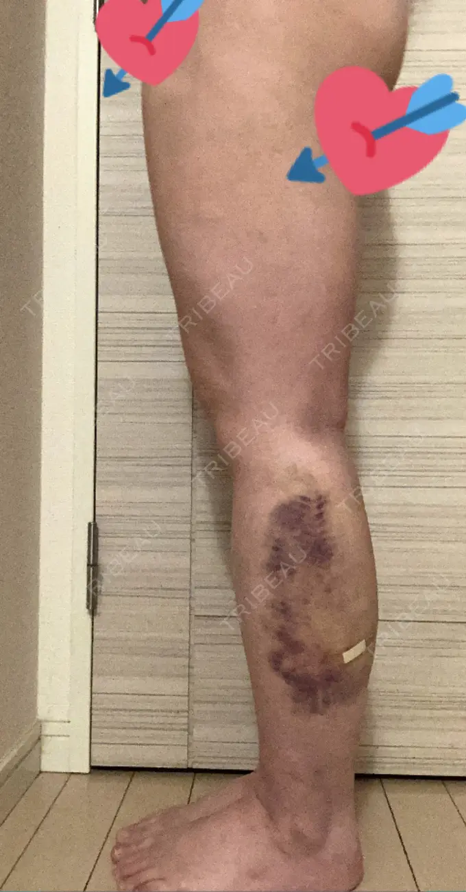 脂肪吸引（脚） / インディバ（お腹） 藤・ナチュレ美容クリニック 恵比寿院 DAY 56 メイン用