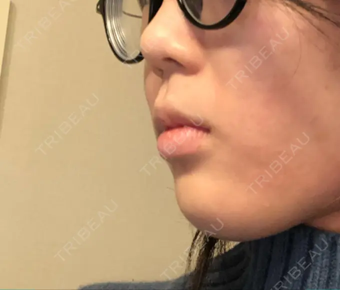 ボトックス（あご） TCB東京中央美容外科 新宿東口院 AFTER メイン用