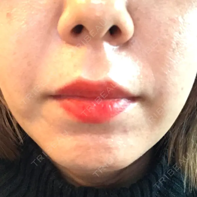 ボトックス（エラ・小顔） TCB東京中央美容外科 心斎橋筋院 DAY 21 メイン用