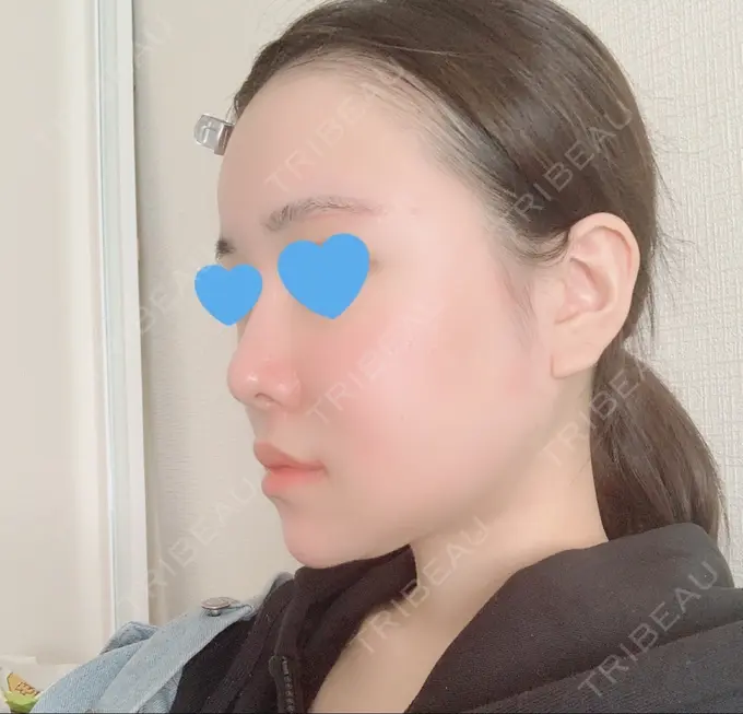 脂肪注入（額） / 脂肪注入（輪郭） スノウ（Snow）整形外科 DAY 26 メイン用