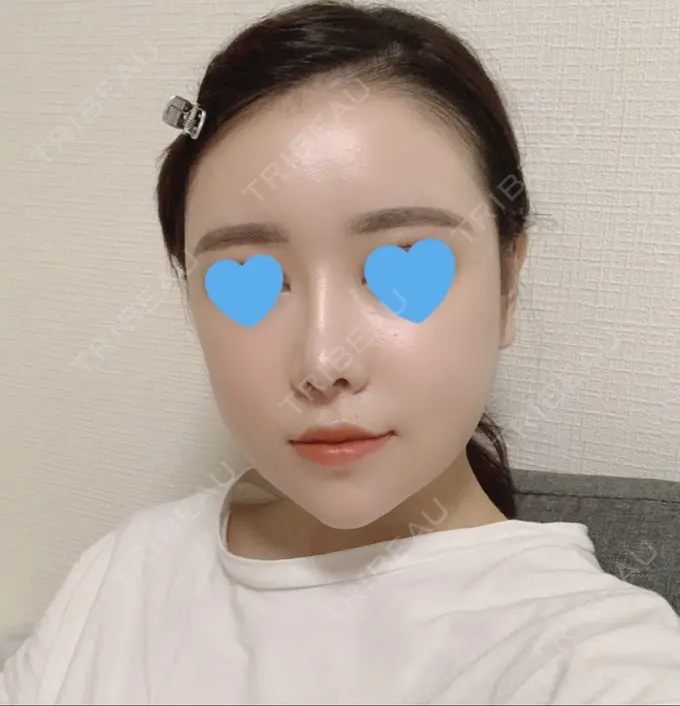 脂肪注入（額） / 脂肪注入（輪郭） スノウ（Snow）整形外科 DAY 25 メイン用