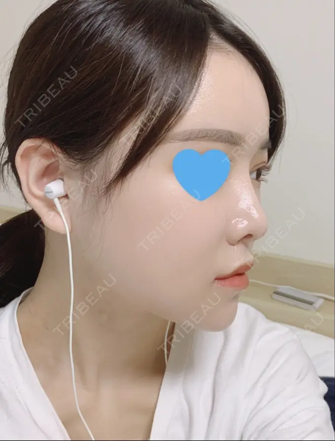 脂肪注入（額） / 脂肪注入（輪郭） スノウ（Snow）整形外科 DAY 25 メイン用