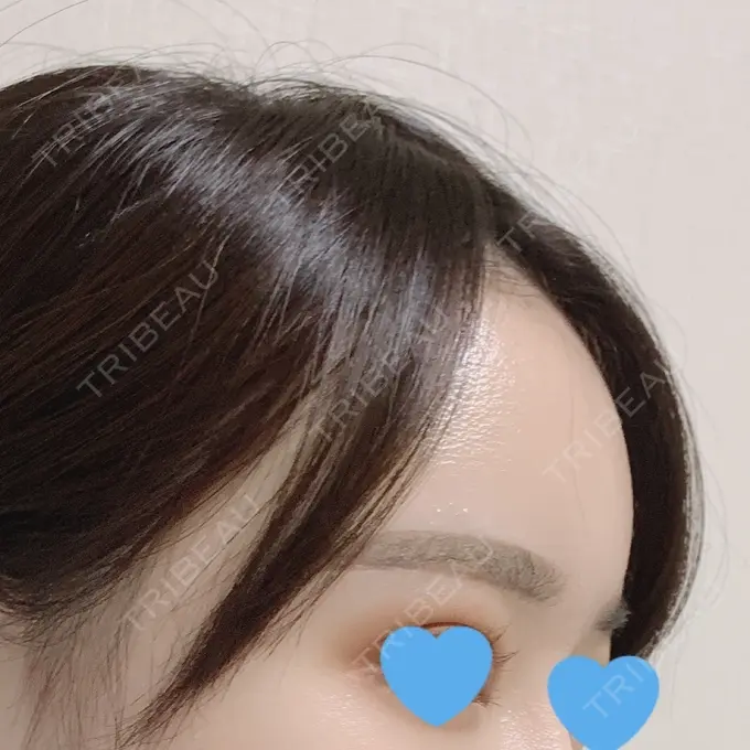 脂肪注入（額） / 脂肪注入（輪郭） スノウ（Snow）整形外科 DAY 25 メイン用