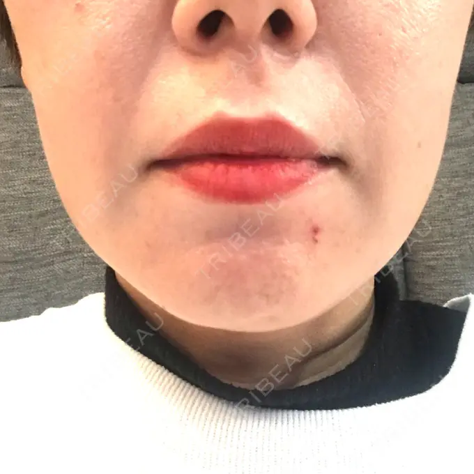 ボトックス（エラ・小顔） TCB東京中央美容外科 心斎橋筋院 DAY 24 メイン用