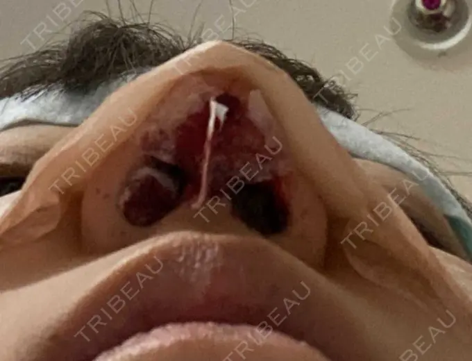 鼻尖形成（切開） / 鼻中隔延長（切開） / 軟骨移植 湘南美容クリニック 藤沢院 DAY 0 メイン用