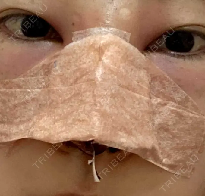 鼻尖形成（切開） / 鼻中隔延長（切開） / 軟骨移植 湘南美容クリニック 藤沢院 DAY 0 メイン用