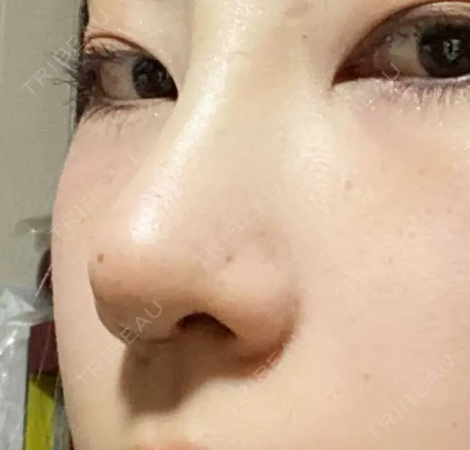 鼻尖形成（切開） / 鼻中隔延長（切開） / 軟骨移植 湘南美容クリニック 藤沢院 AFTER メイン用