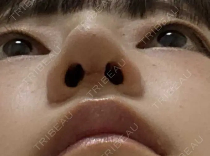 鼻尖形成（切開） / 鼻中隔延長（切開） / 軟骨移植 湘南美容クリニック 藤沢院 DAY 293 メイン用