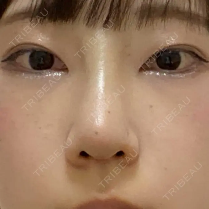 鼻尖形成（切開） / 鼻中隔延長（切開） / 軟骨移植 湘南美容クリニック 藤沢院 DAY 293 メイン用